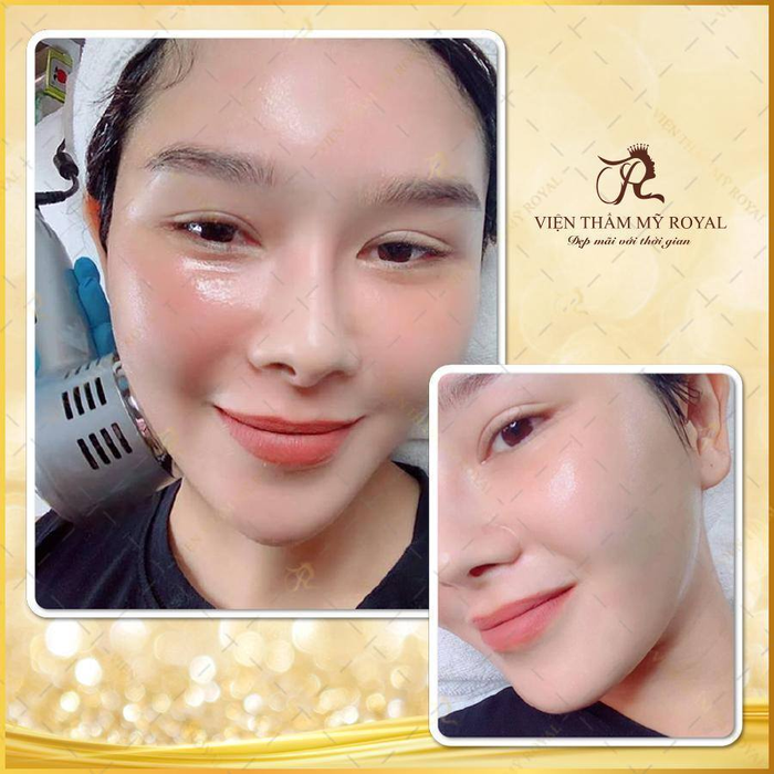 Hệ thống máy móc Laser CO2 hiện đại tại Royal