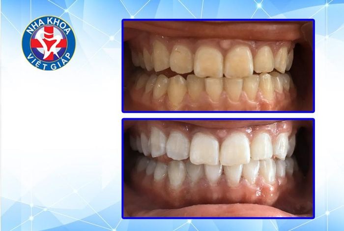 Nha Khoa Việt Giáp Thái Nguyên - Hình Ảnh 2