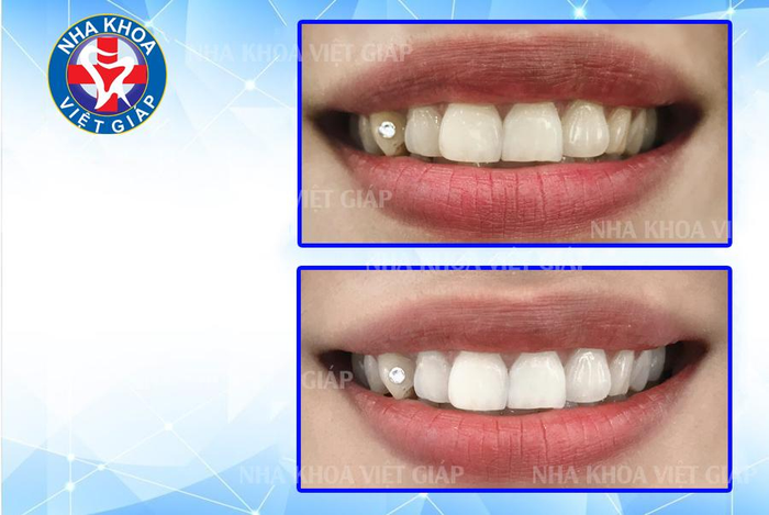 Nha Khoa Việt Giáp Thái Nguyên - Hình Ảnh 1