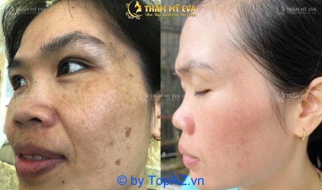 Điều trị nám và tàn nhang uy tín tại Bình Dương