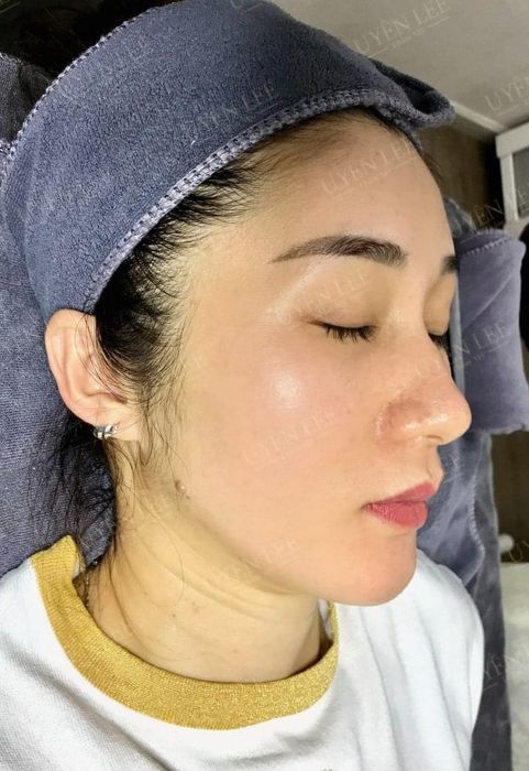 Hình ảnh thực tế tại Thẩm Mỹ Uyên Lee
