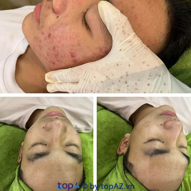 Sunny Spa & Nails - Địa chỉ trị mụn chuẩn y khoa hàng đầu quận Cẩm Lệ