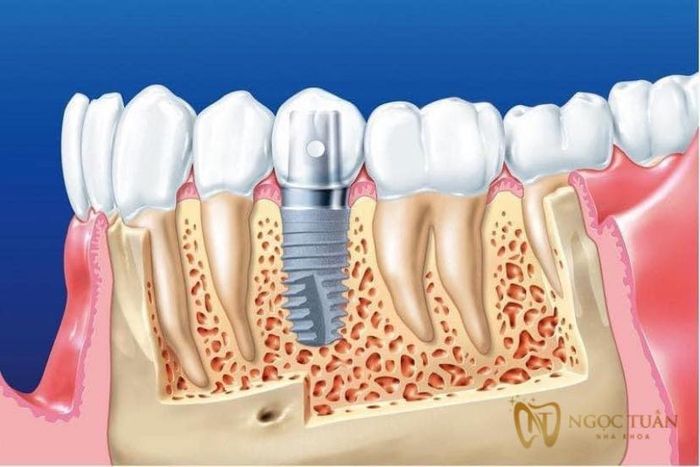 NHA KHOA NGỌC TUẤN - Cơ sở uy tín chuyên trồng răng implant tại Thái Bình