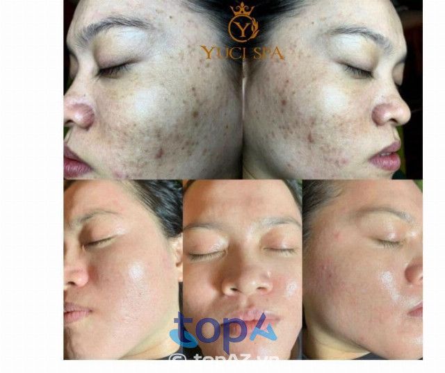 Yuci Spa - Nơi gửi trọn niềm tin cho làn da sạch mụn