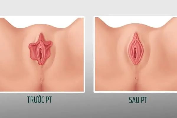 Hình ảnh mô phỏng kết quả cắt môi bé ấn tượng được thực hiện bởi đội ngũ bác sĩ giàu kinh nghiệm tại Thẩm mỹ Dr. Duy