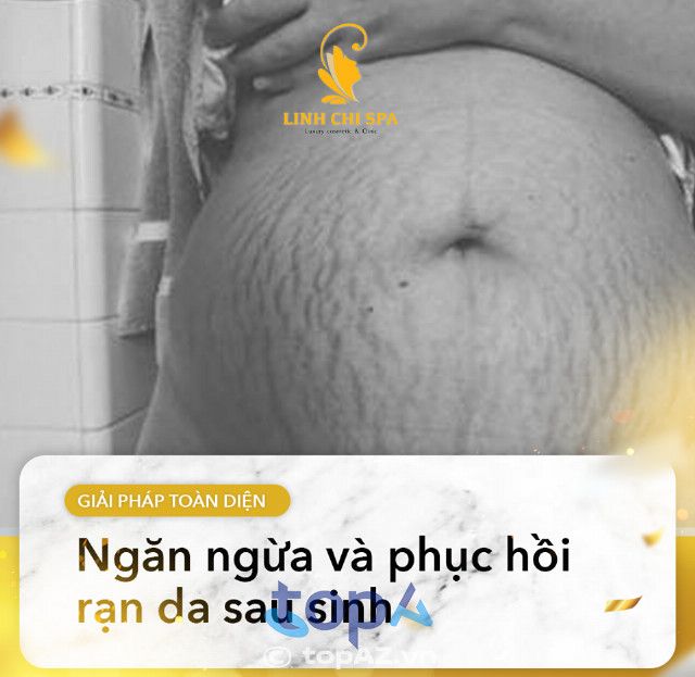 Linh Chi Spa - Địa chỉ vàng trị rạn da tại Thái Bình