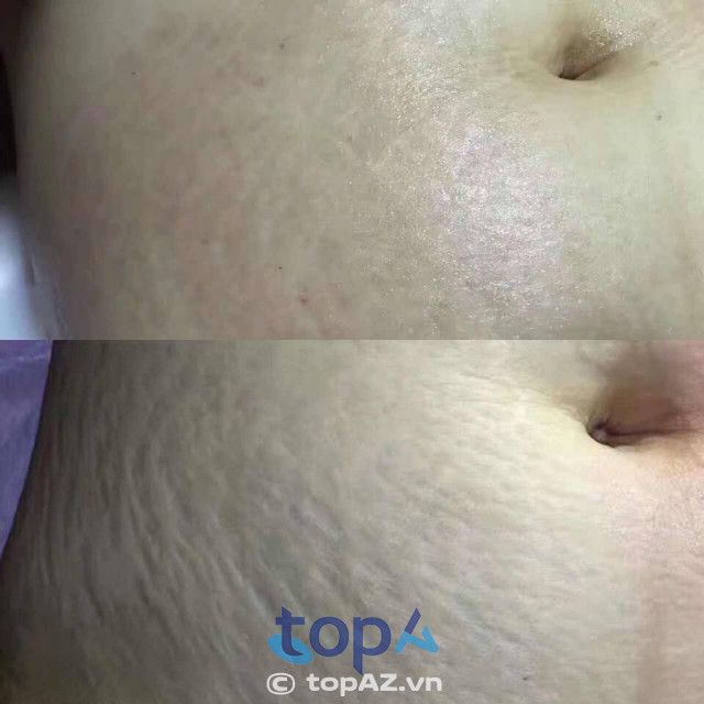 Viện Thẩm Mỹ Lan Hương - Địa chỉ vàng trị rạn da công nghệ cao tại Thái Bình