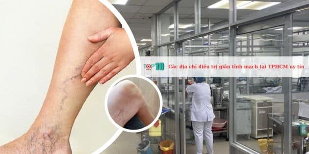Danh sách các địa chỉ điều trị giãn tĩnh mạch chất lượng tại TPHCM