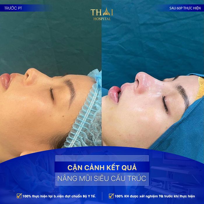 Hình ảnh cơ sở hiện đại và kết quả nâng mũi tại Viện Thẩm Mỹ Thai Hospital