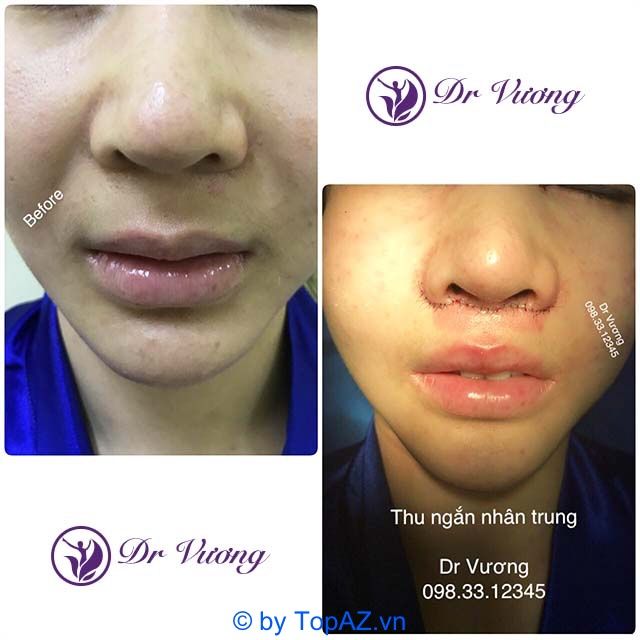 Dịch vụ thu ngắn nhân trung chất lượng cao tại TP.HCM