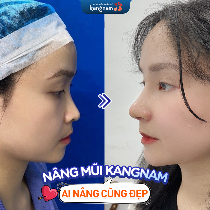 Hình ảnh kết quả nâng mũi ấn tượng tại Bệnh Viện Thẩm Mỹ Kangnam