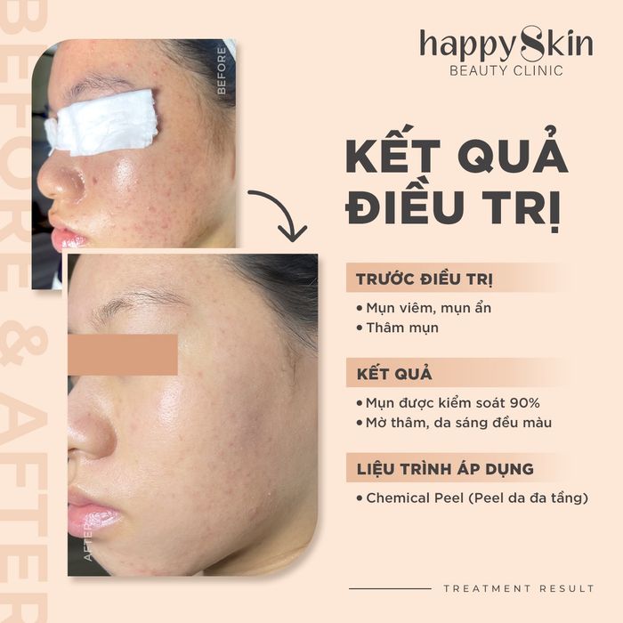 Hình ảnh kết quả điều trị tại Happy Skin Beauty Clinic