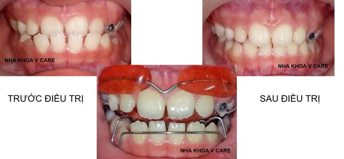 Quy trình điều trị chuẩn quốc tế tại Nha Khoa Vcare - Ảnh 3