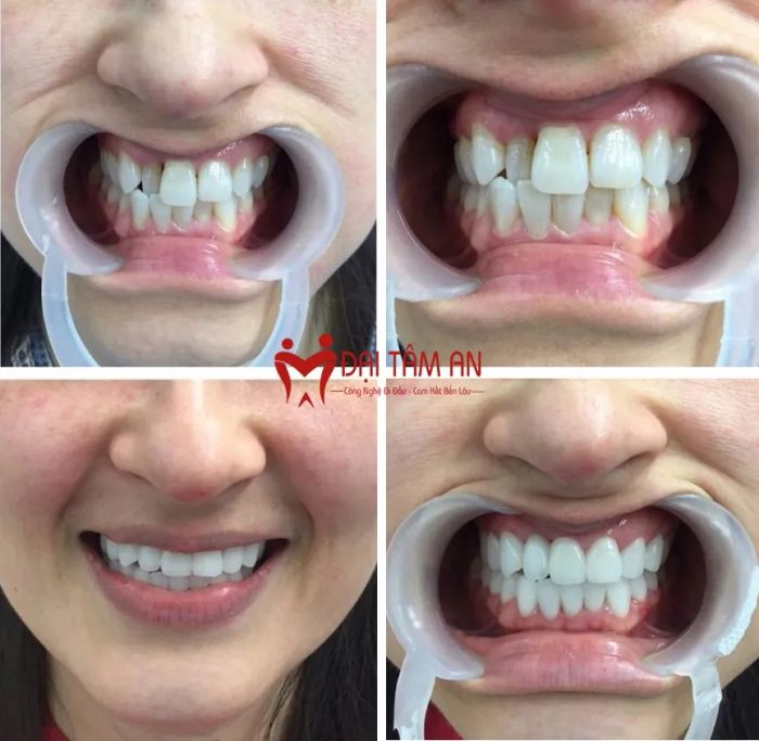 Quy trình điều trị chuyên nghiệp tại Nha Khoa Đại Tâm An - Ảnh 3