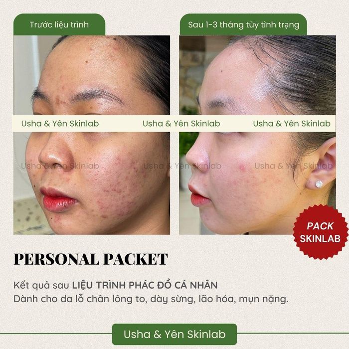 Hình ảnh liệu trình chăm sóc da tại Yên Spa & Skinlab