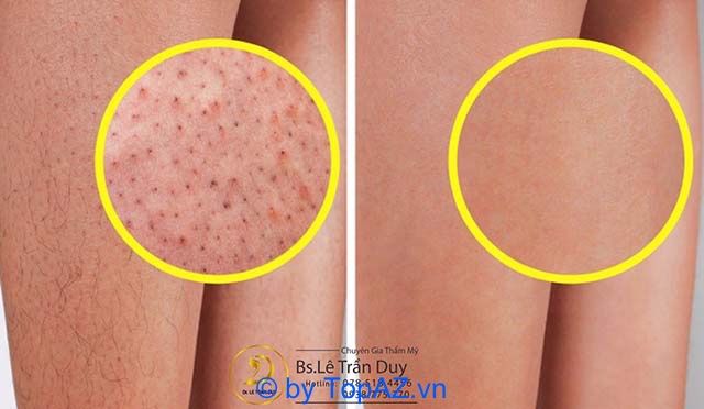 trị viêm nang lông tại tphcm
