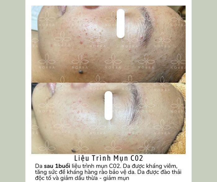 Hình ảnh kết quả điều trị tại NORRA Spa
