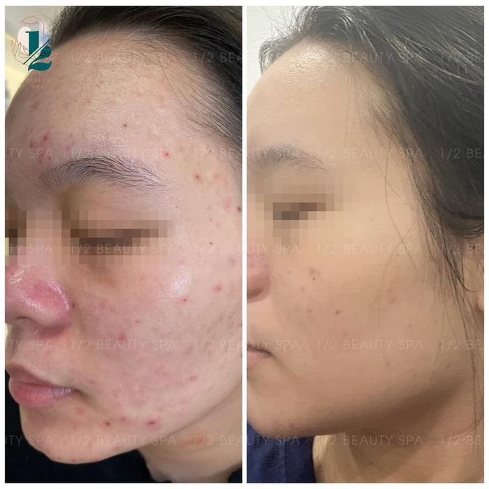 Hình ảnh liệu trình điều trị tại 1/2 Beauty Spa