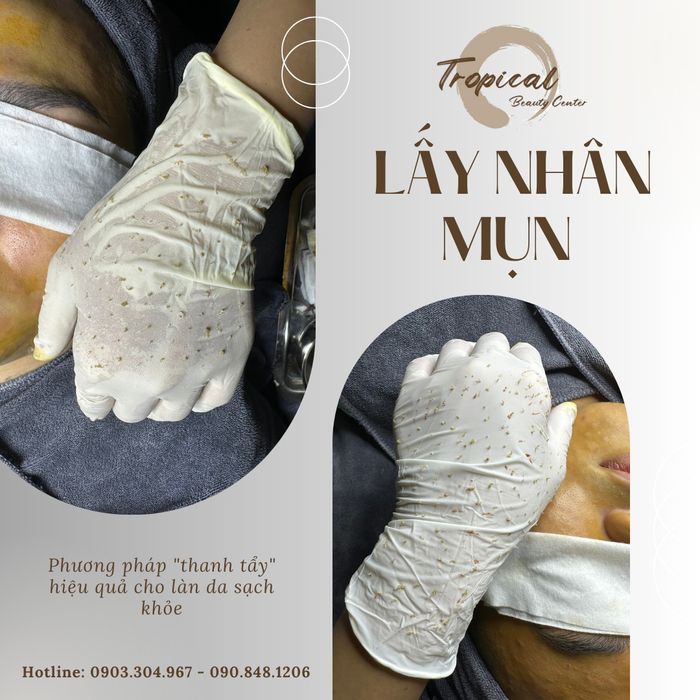 Hình ảnh liệu trình điều trị tại Tropical Beauty Center
