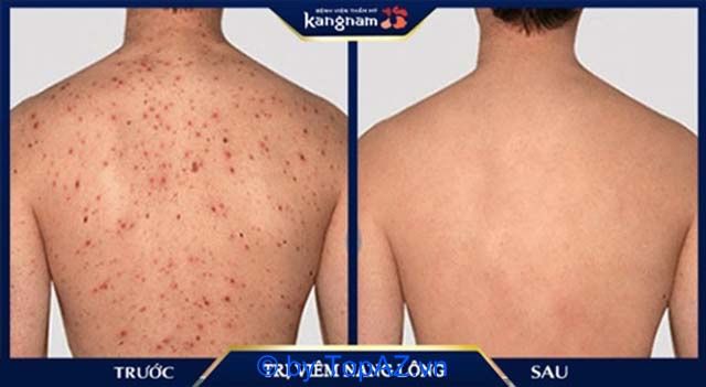 Điều trị viêm nang lông ở đâu tại TPHCM