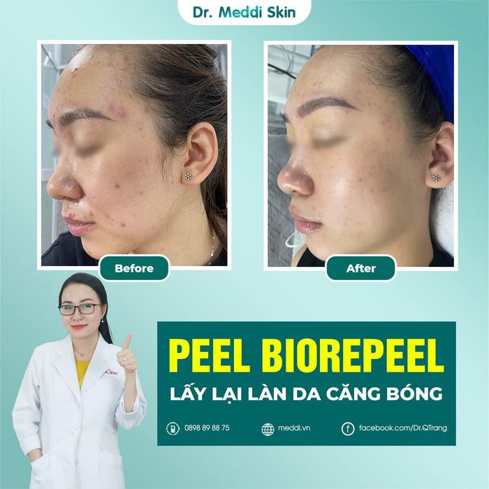 Hình ảnh liệu trình điều trị tại Meddi Skin
