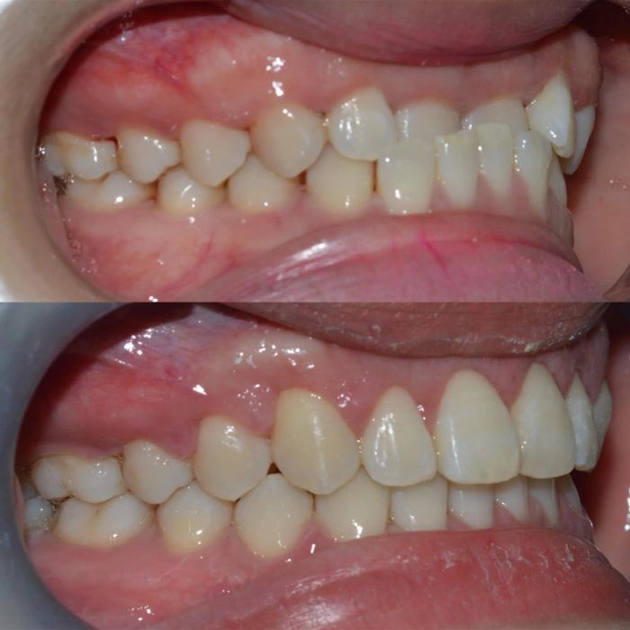 Hình ảnh thực tế về quy trình điều trị tại Nha khoa Nhân Tâm - Ảnh 3