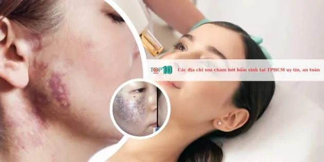 Danh sách các cơ sở xóa chàm bớt bẩm sinh đáng tin cậy nhất tại TP.HCM