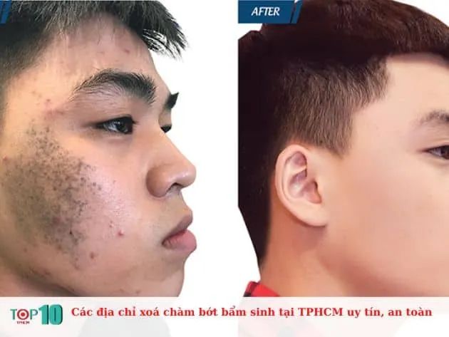 Top địa chỉ xóa chàm bớt bẩm sinh đáng tin cậy nhất tại TP.HCM