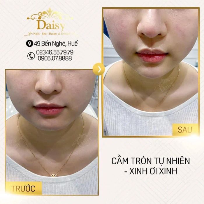 Quy trình tiêm chuẩn Hàn Quốc tại Daisy