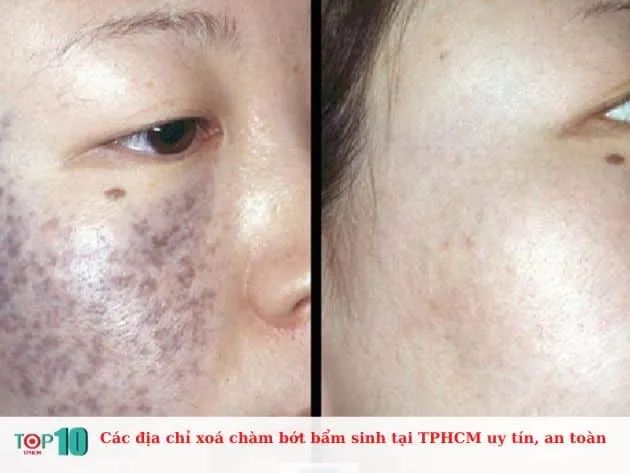 Danh sách địa chỉ xóa chàm bớt bẩm sinh đạt chuẩn y khoa tại TP.HCM