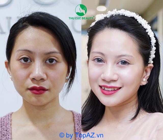 Địa chỉ tiêm Mesotherapy uy tín và chất lượng hàng đầu tại Hà Nội