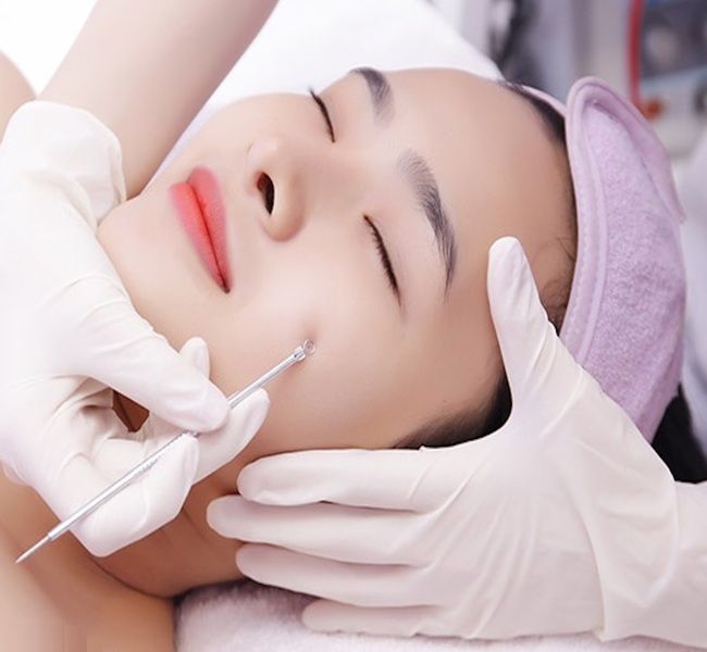 Hình ảnh minh họa (Nguồn: Internet) - Công nghệ trị mụn hiện đại