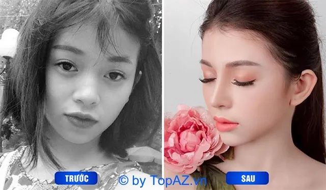 Bộ sưu tập hình ảnh khách hàng trước và sau khi nâng mũi Queenform