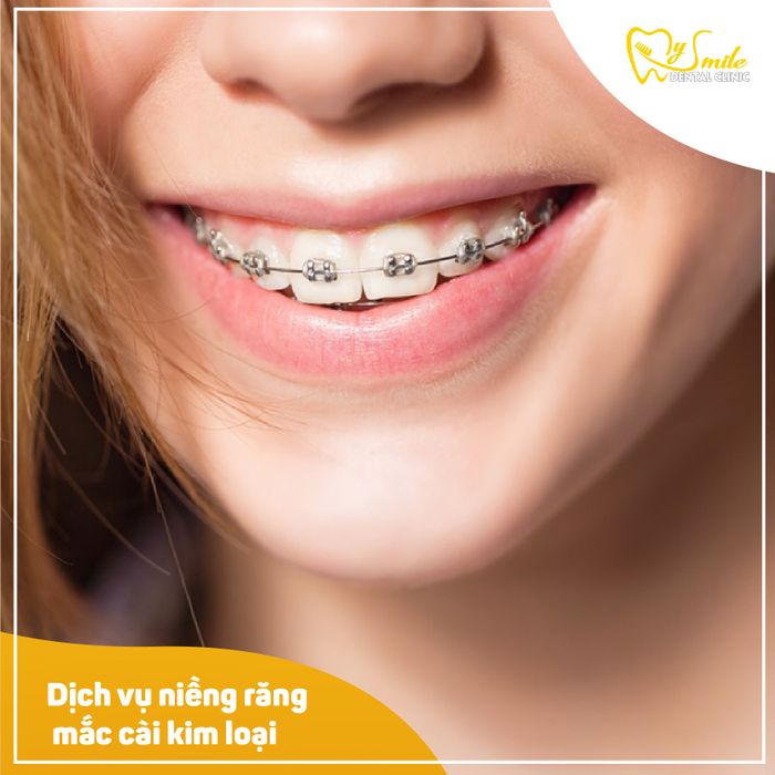 Quy trình niềng răng chuyên nghiệp tại Nha Khoa My Smile