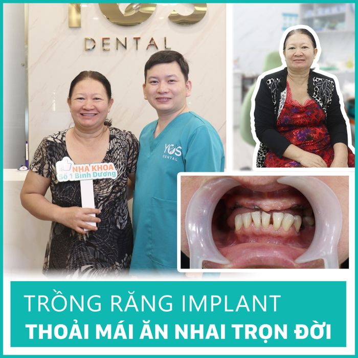 Hình ảnh quy trình trồng răng Implant chuẩn xác tại Nha khoa Sài Gòn Bình Dương