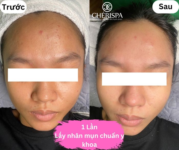 Ảnh minh họa tại Chérispa Quảng Ngãi