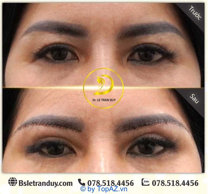 Tại sao lại cần nâng cung chân mày? Đây là câu hỏi mà nhiều người đặt ra khi muốn cải thiện vẻ ngoài và duy trì sự tươi trẻ cho khuôn mặt.