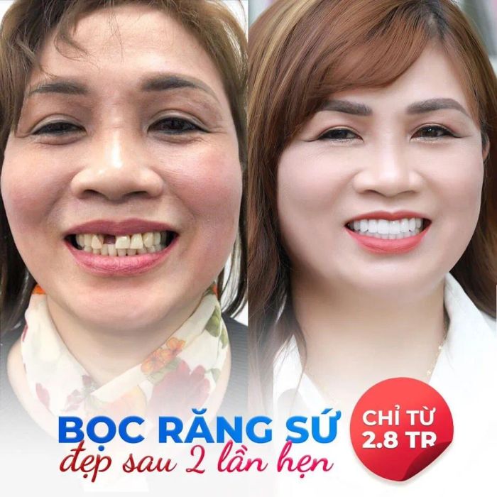 Hình ảnh quy trình bọc răng sứ chuẩn Pháp tại Nha Khoa Paris