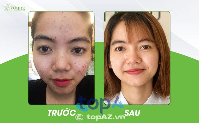 nơi trị mụn đáng tin cậy tại TP.HCM