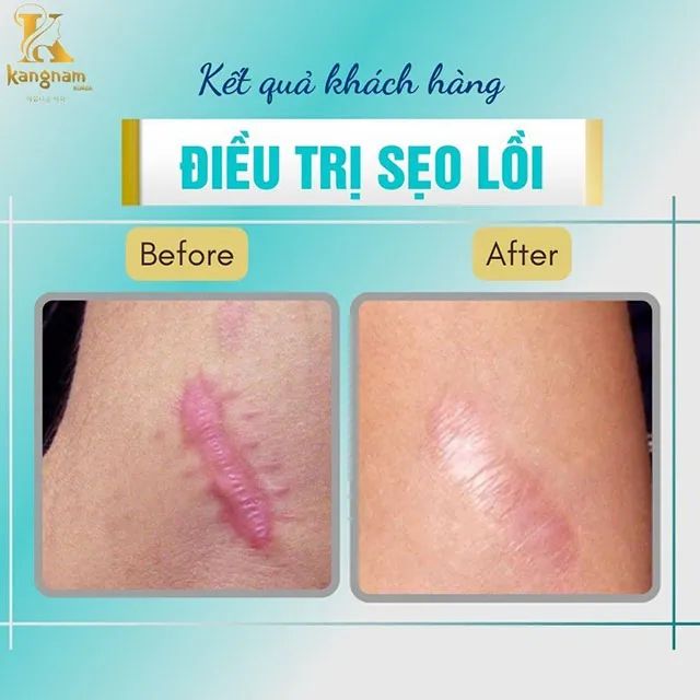 Địa chỉ vàng trị thâm sẹo tại Gia Lai