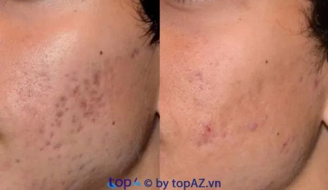 Địa chỉ trị thâm sẹo chuẩn y khoa tại Gia Lai