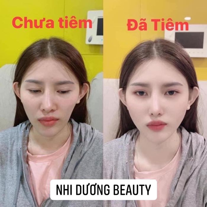 Bộ sưu tập hình ảnh khách hàng trước và sau khi sử dụng dịch vụ tại Nhi Dương Beauty