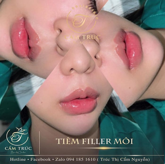 Bộ sưu tập hình ảnh khách hàng trước và sau khi sử dụng dịch vụ tại Cẩm Trúc Beauty Center