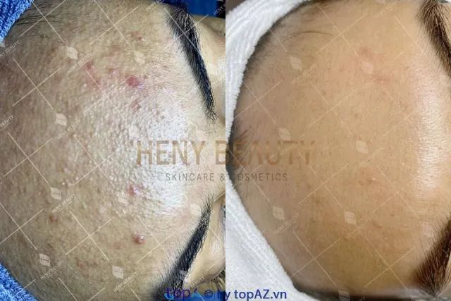 Địa chỉ trị thâm sẹo chuẩn y khoa tại Gia Lai