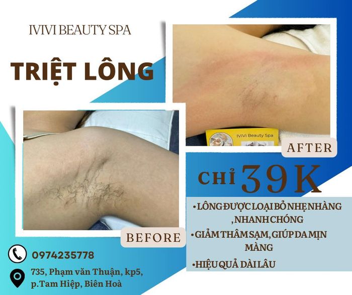 Hình ảnh IViVi Beauty Spa - Công nghệ triệt lông hàn băng tiên tiến