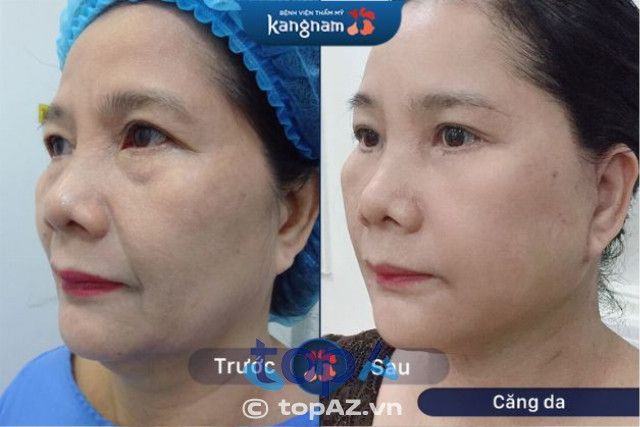 Bệnh viện Thẩm mỹ Kangnam - Tiên phong trong lĩnh vực trẻ hóa da mặt