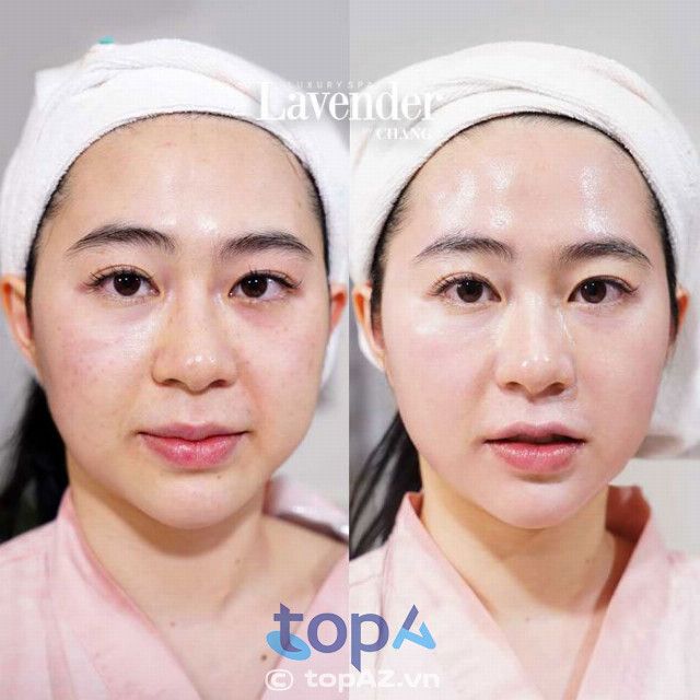 Hệ thống thẩm mỹ viện Lavender by Chang - Địa chỉ vàng cho dịch vụ căn da mặt tại Hà Nội