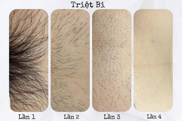 Hình ảnh Dr Duyen Spa - Quy trình triệt lông chuẩn y khoa