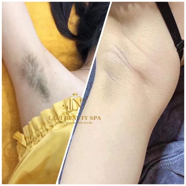 Hình ảnh Lani Beauty Spa - Quy trình triệt lông chuyên nghiệp