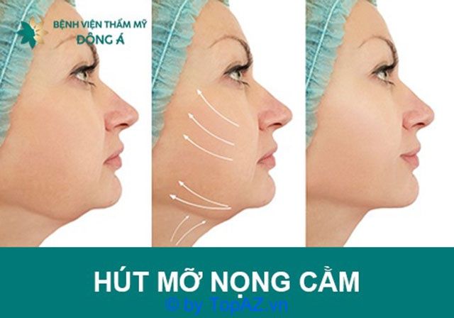 Địa chỉ xóa nọng cằm uy tín tại TP.HCM